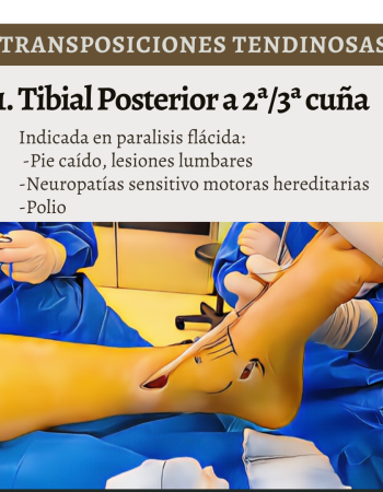 transposiciones tendinosas 2