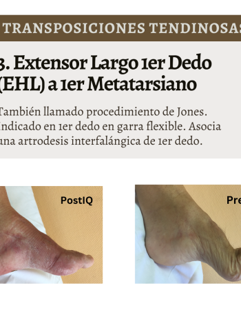 transposiciones tendinosas 4