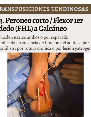 transposiciones tendinosas 5