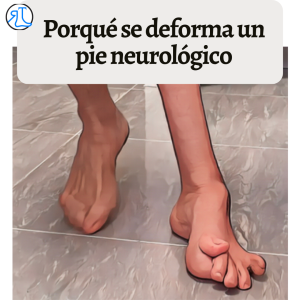 porque se deforma un pie neurológico 1