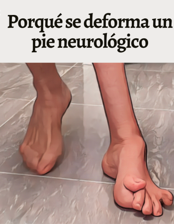 porque se deforma un pie neurológico 1