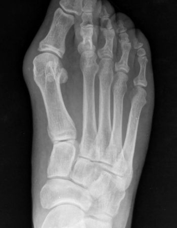 crugia-percutanea-tercera-generacion-hallux-valgus-01