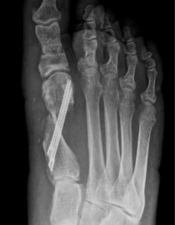 crugia-percutanea-tercera-generacion-hallux-valgus-02