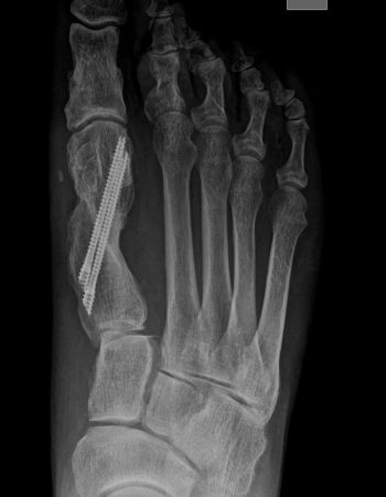 crugia-percutanea-tercera-generacion-hallux-valgus-03