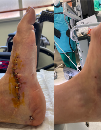 pre y postquirurgica pie polio lateral