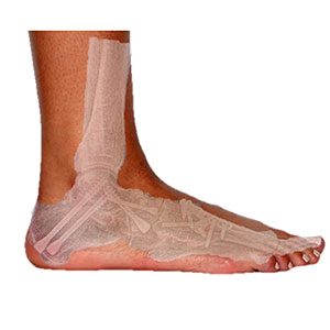 raul-torre-artrodesis-tratamiento