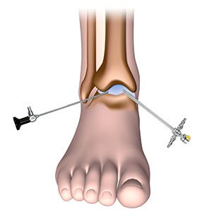 raul-torre-artroscopia-tobillo-tratamiento