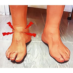 raul-torre-artrosis-de-tobillo-patologia-01