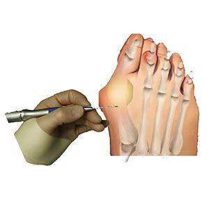 raul-torre-cirugia-percutanea-tratamiento