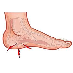 raul-torre-fascitis-patologia
