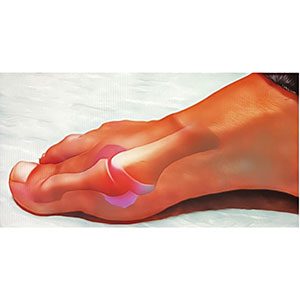 raul-torre-hallux-rigidus-patologia