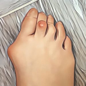 raul-torre-hallux-valgus-patologia