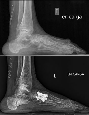 Pre y post artrodesis y transferencia tendinosa